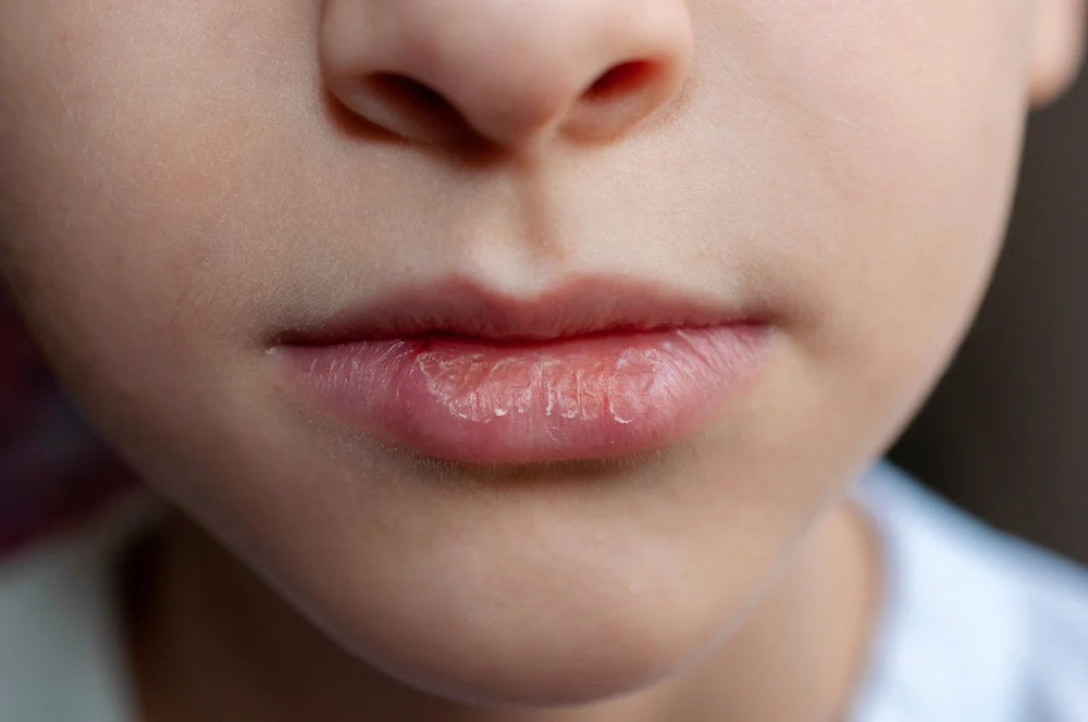 Little Lips, Big Woes: What No One Tells You About Chapped Lips in Babies & Toddlers