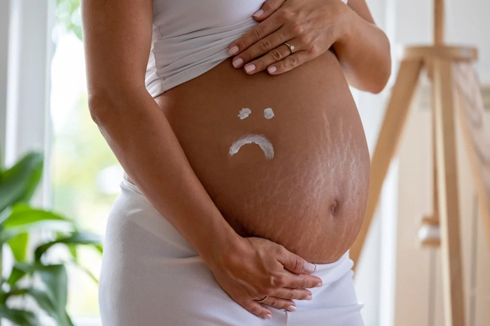 Pregnancy Stretch Marks: Causes and Prevention Tips